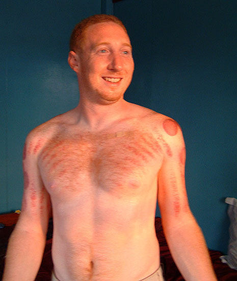  Hot cups massage - on the front you can see the scraping which was done with the back of a metal spoon. It hurt like hell, but the big grin comes from the amusement over the experience.
